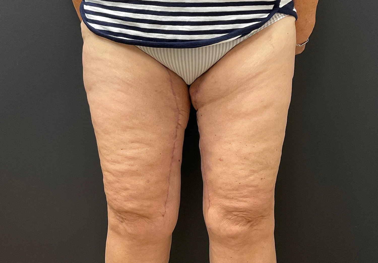 FORM-Toronto-Body-Contouring-Thigh-Lift-Before-After