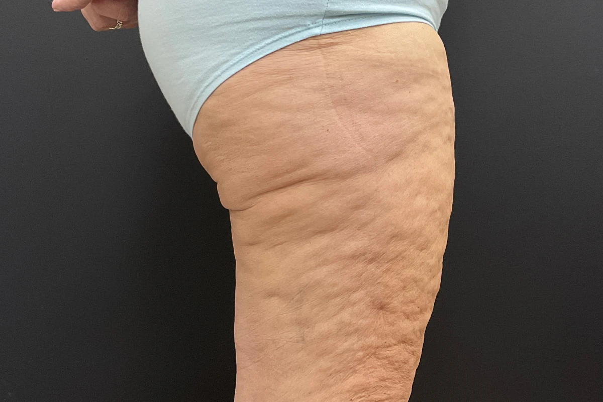 FORM-Toronto-Body-Contouring-Thigh-Lift-Before-After