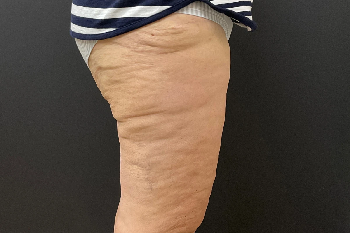 FORM-Toronto-Body-Contouring-Thigh-Lift-Before-After-35.4