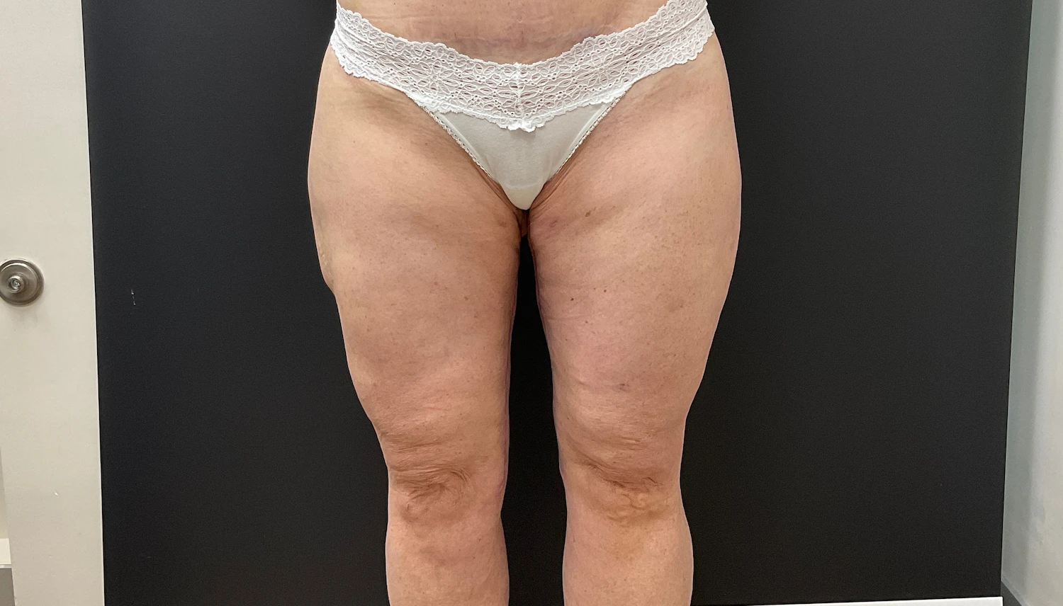 FORM-Toronto-ThighLift-BeforeAfter