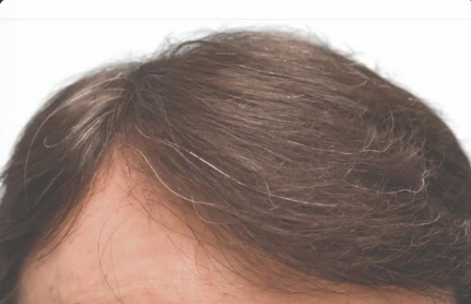 12 months after Robotic Hair Restoration