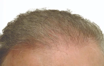 10 months after Robotic Hair Restoration