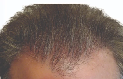 8 months after Robotic Hair Restoration