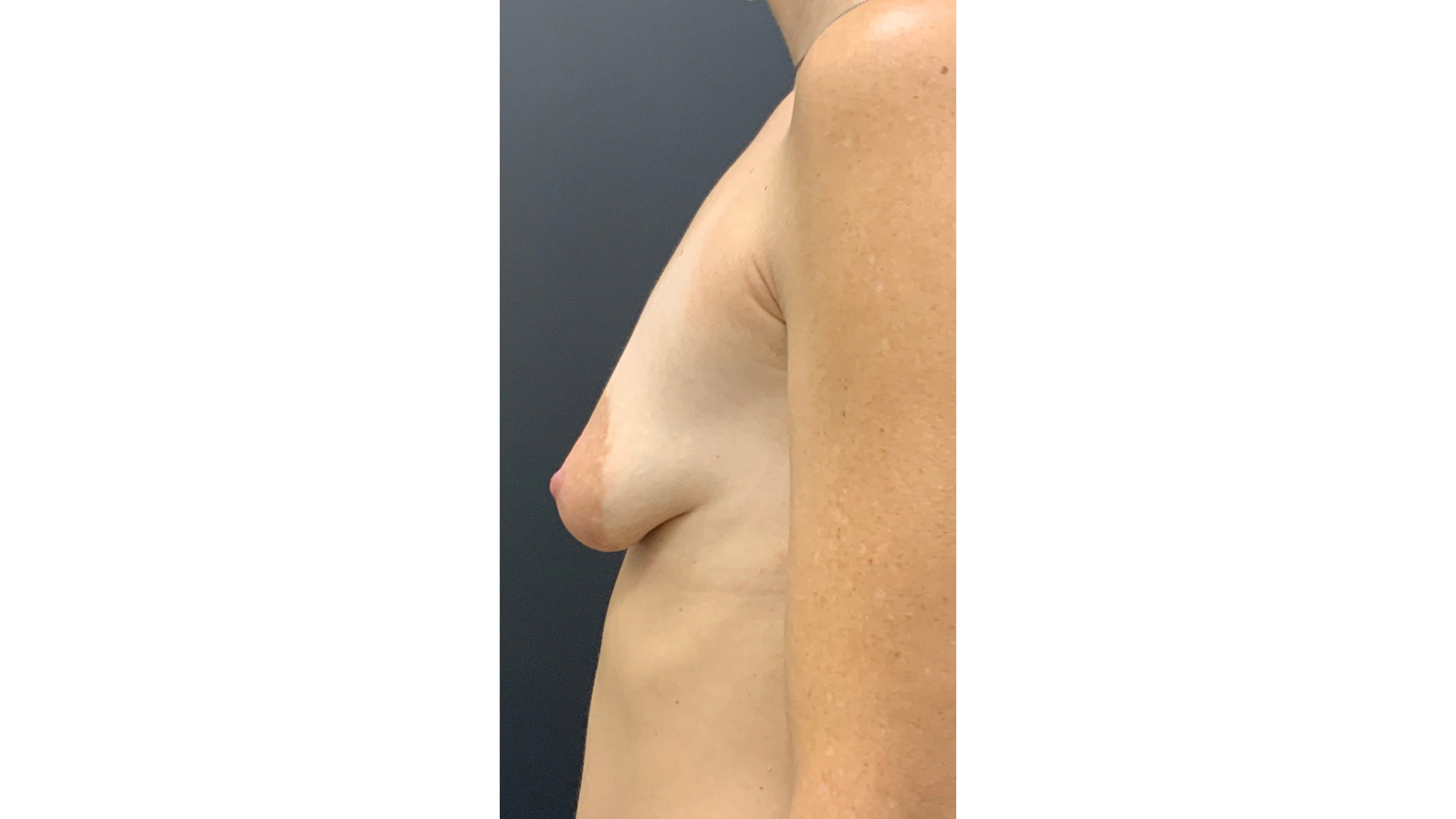 Pt 41102 Before 3 Breast Aug and Mastopexy