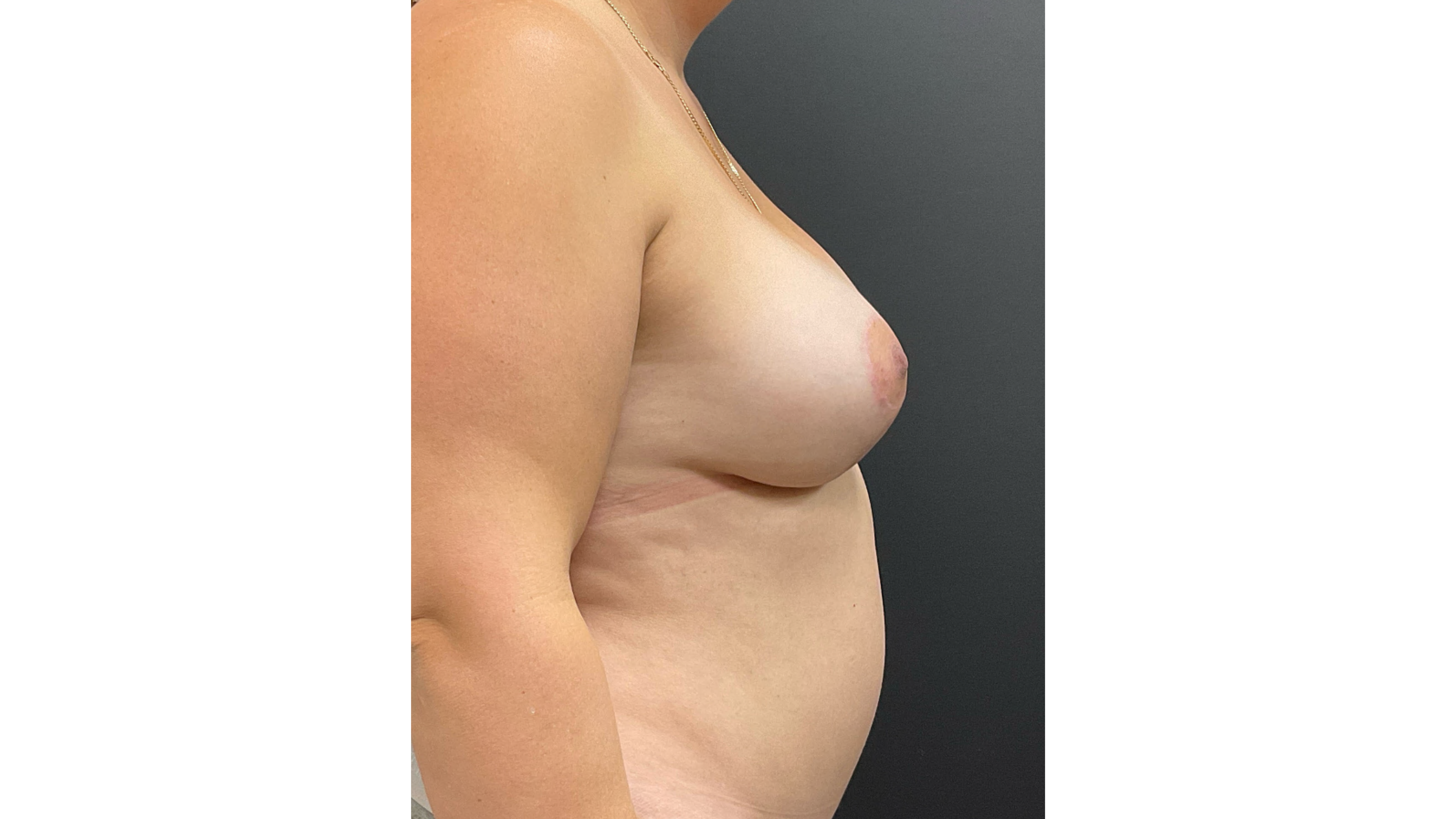 Pt 47418 - After 3 -Breast Aug and Mastopexy