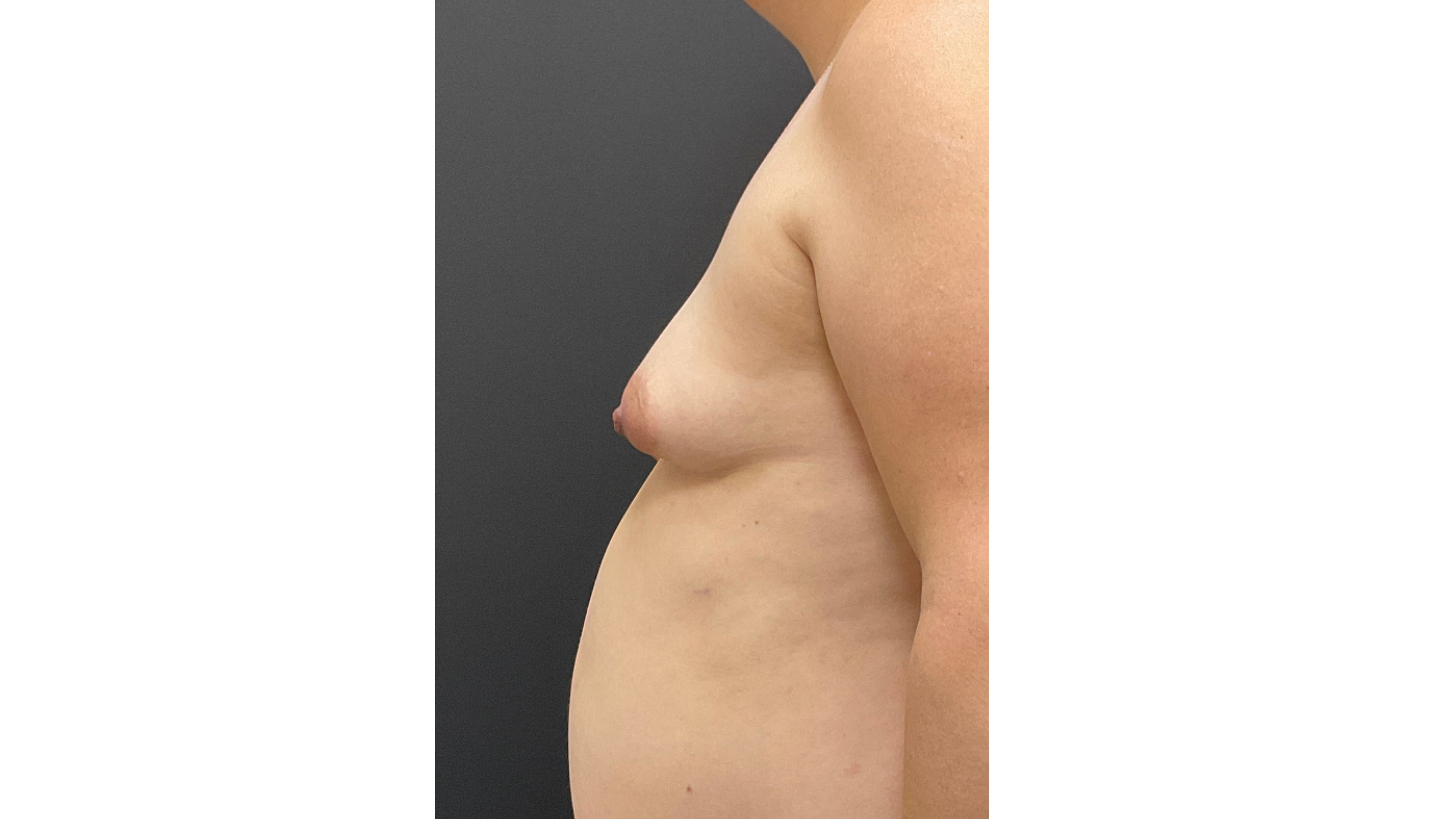 Pt 47418 - Before 2 -Breast Aug and Mastopexy