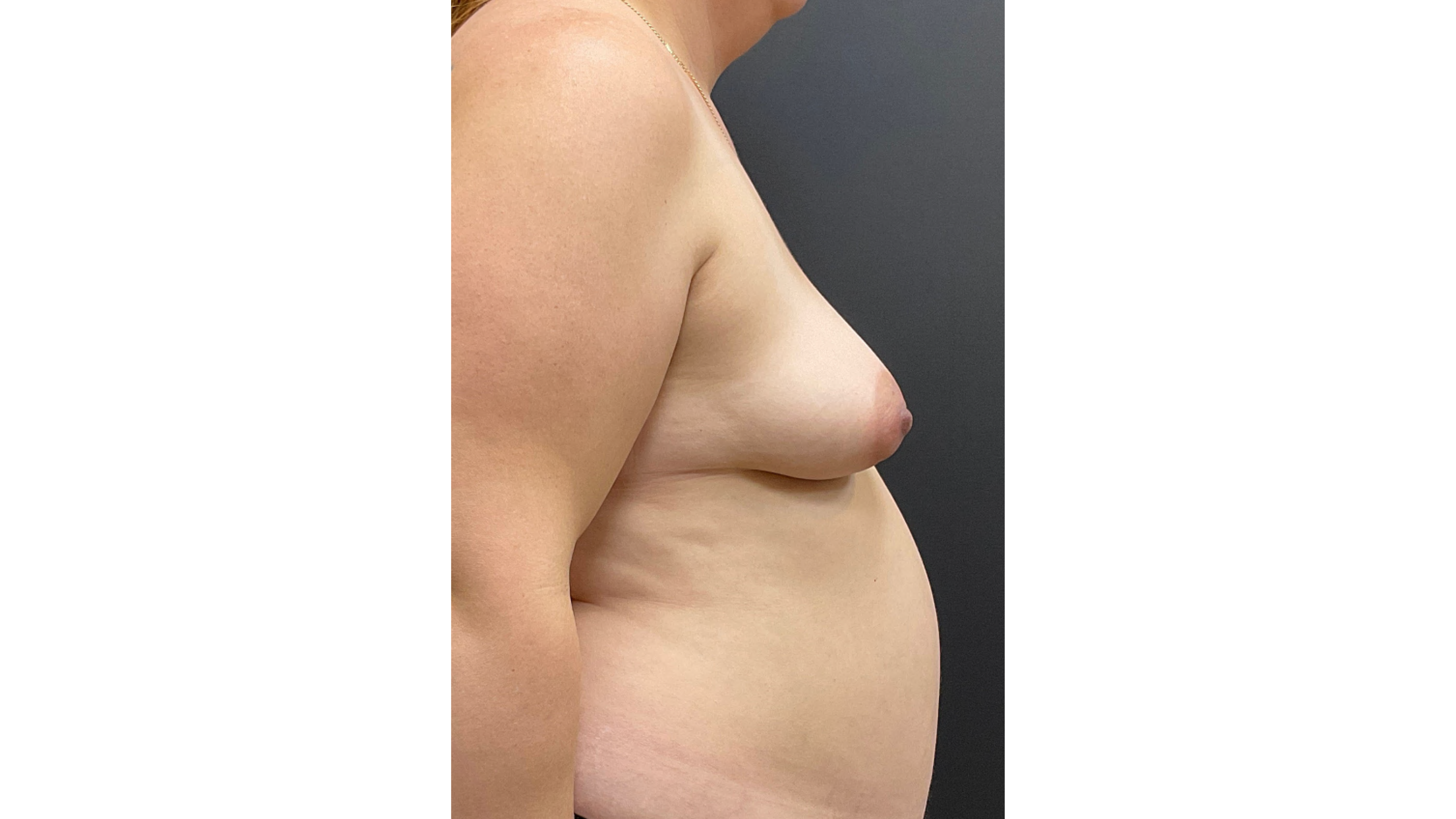 Pt 47418 - Before 3 -Breast Aug and Mastopexy